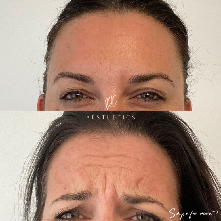 Cosmetic Injectables Before And After Gold Coast Dc Aesthetics