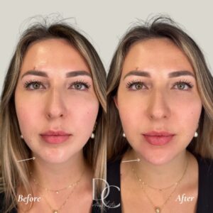 chin filler before after dc aesthetics