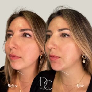 chin filler before after gold coast