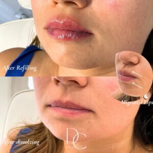 Lip filler beforer after cosmetic injectables Gold Coast