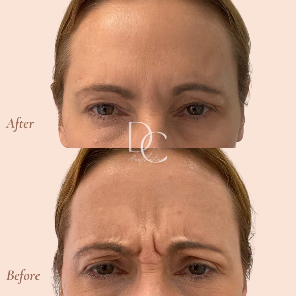 anti wrinkle treatment before after 3