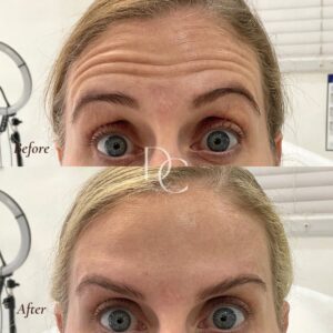 anti-wrinkle-before-after-5