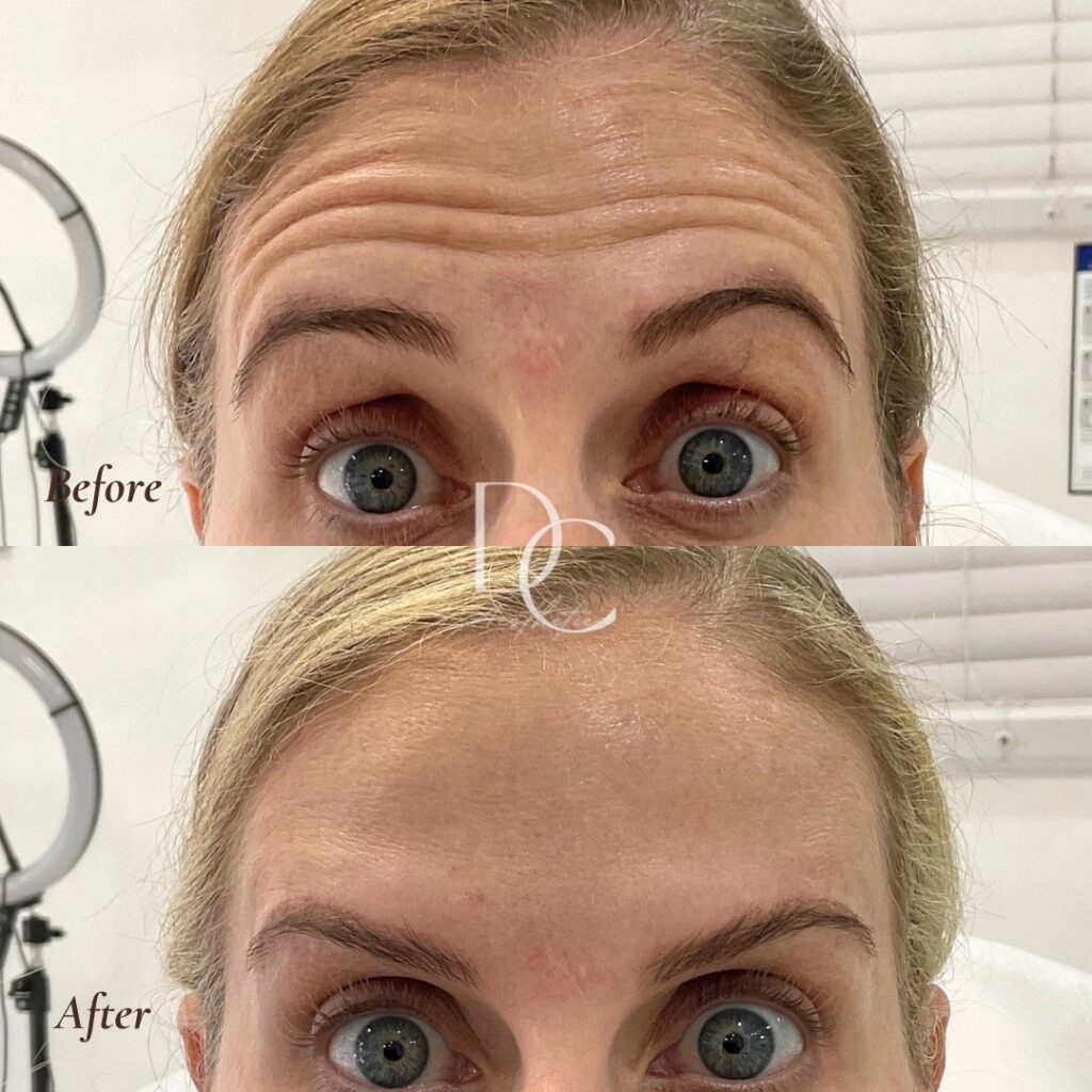 anti wrinkle treatment before after 5