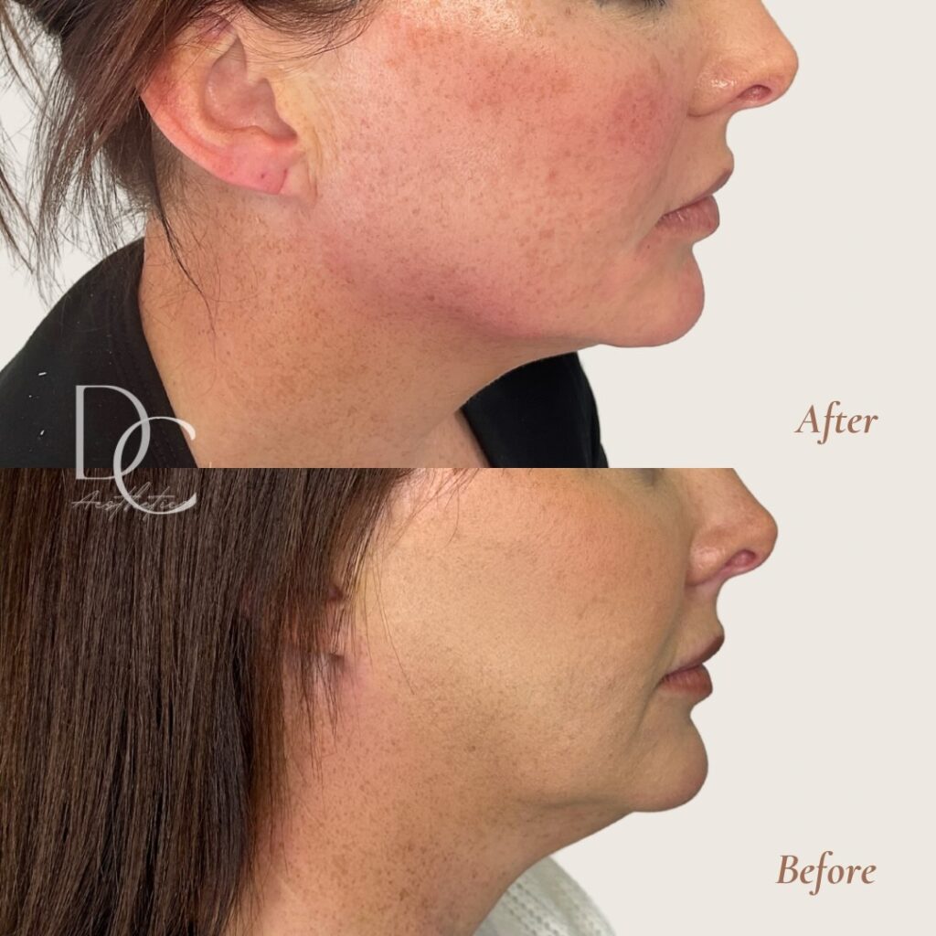 cosmetic injectables gold coast jawline
