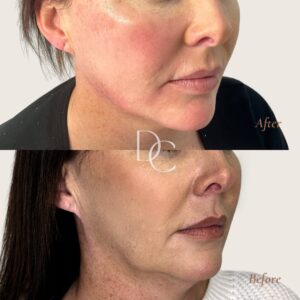 cosmetic injections jawline before after