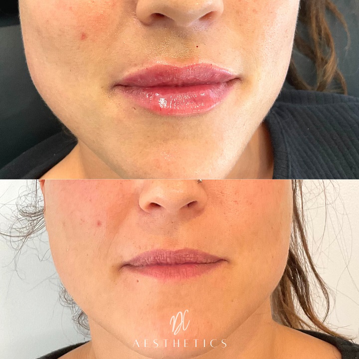Lip filler injections Gold Coast
