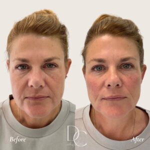 cheek filler before after injections gold coast