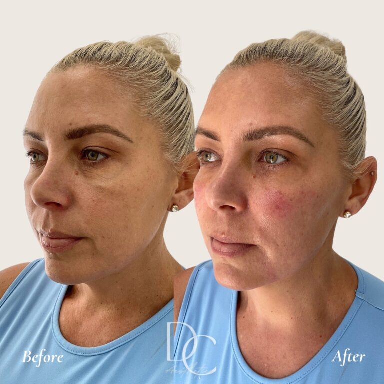 cheek filler cosmetic injectables gold coast