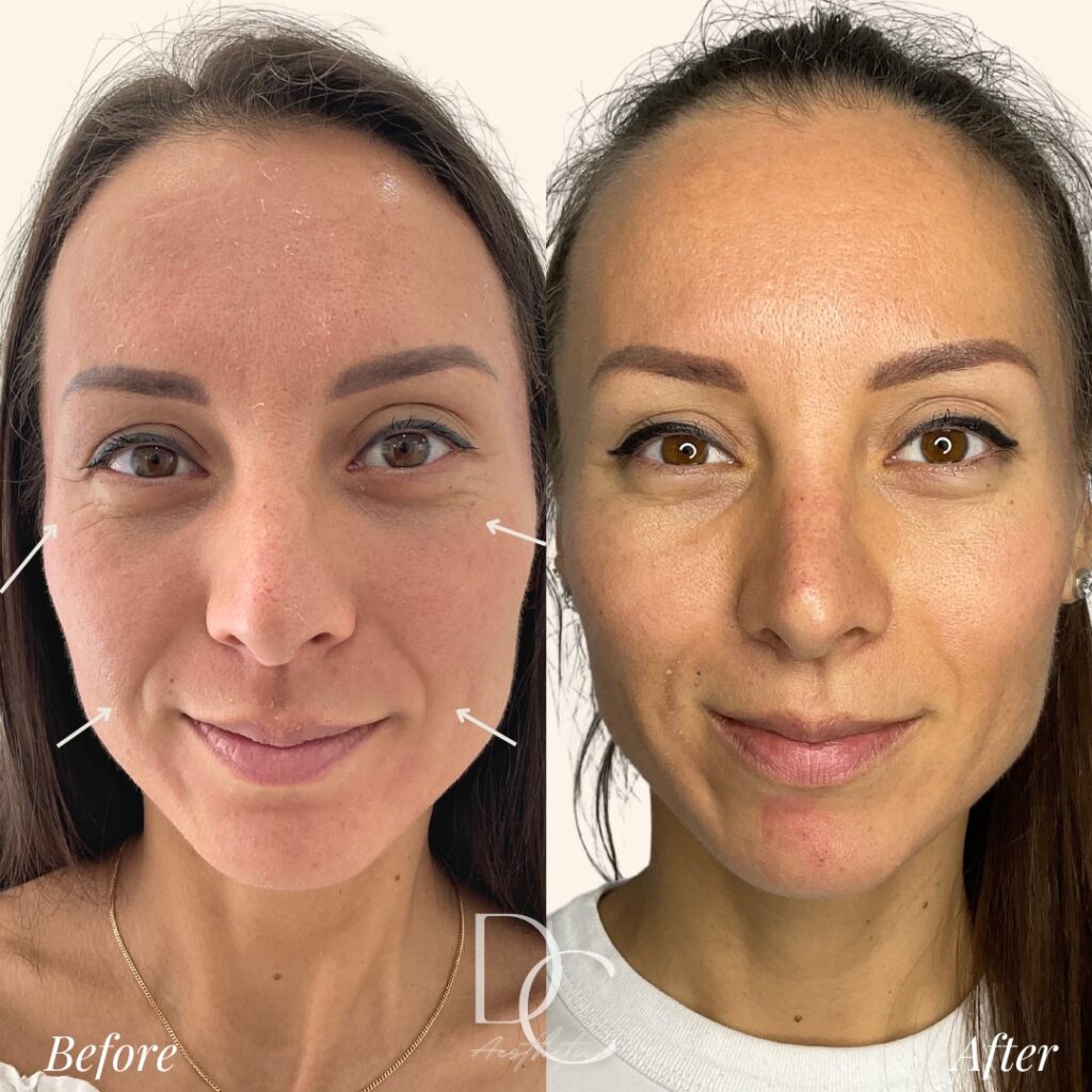 PRP Face treatment before and after
