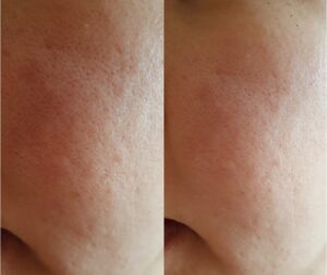 before-after-exosomes-skin-gold-coast