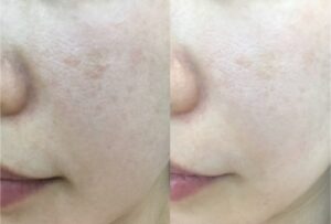 before-after-skin-dc-aesthetics