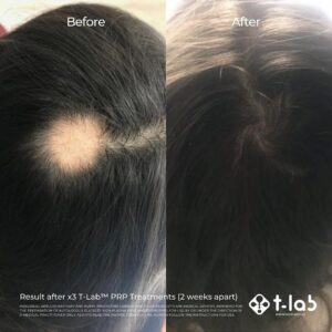 prf treatment hair regrowth