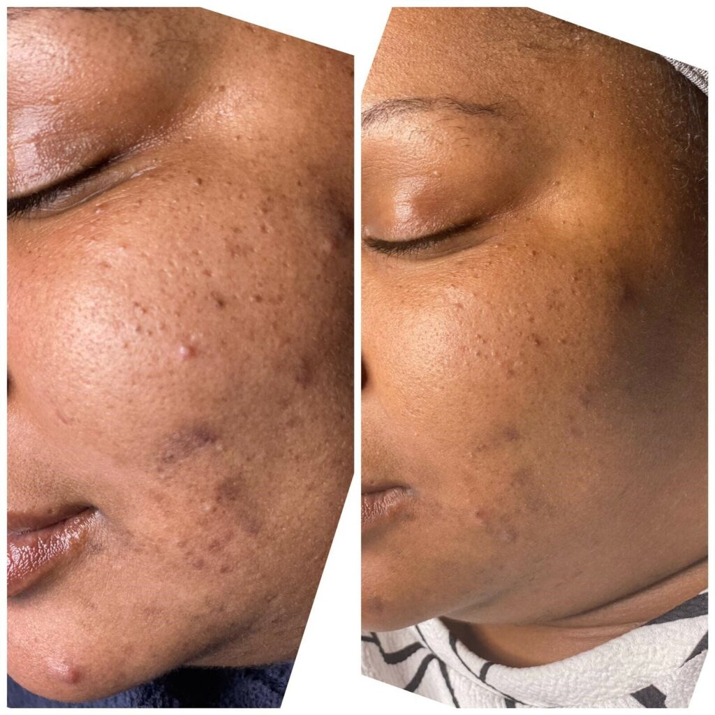 Bio Re Peel Before And After BioRePeel | DC Aesthetics